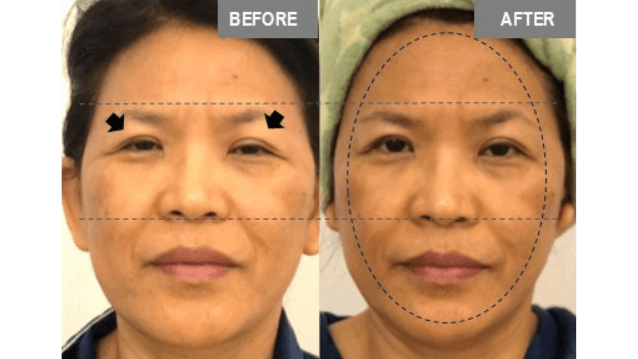 Vorher-Nachher Vergleich Augenpartie und V-Form Gesicht — FaceBodyLift Bern