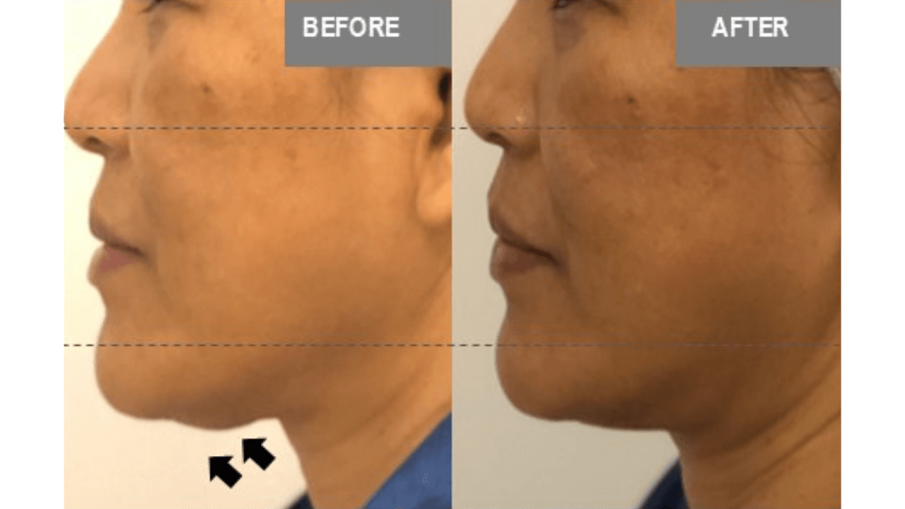 Vorher-Nachher Vergleich Doppelkinn — FaceBodyLift Bern