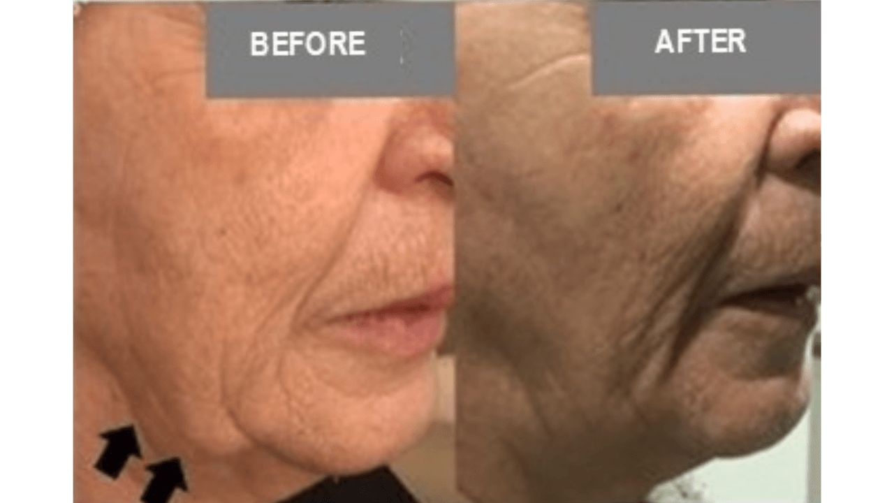 Vorher-Nachher Vergleich Halsstraffung — FaceBodyLift Bern