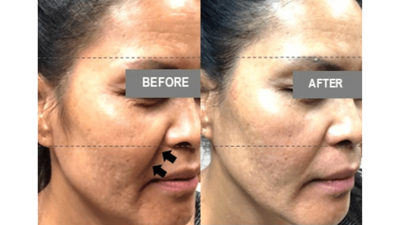 Vorher-Nachher Vergleich Hauterschlaffung — FaceBodyLift Bern
